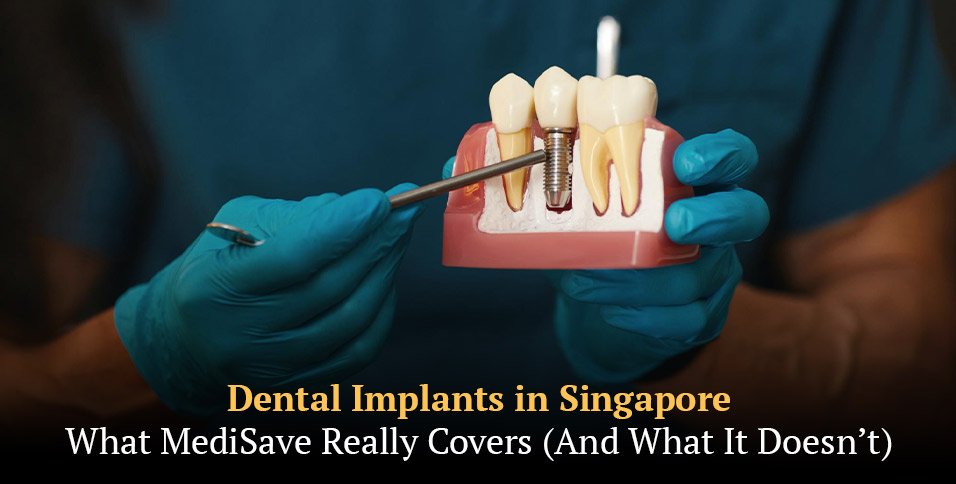 Dental Implants in Singapore