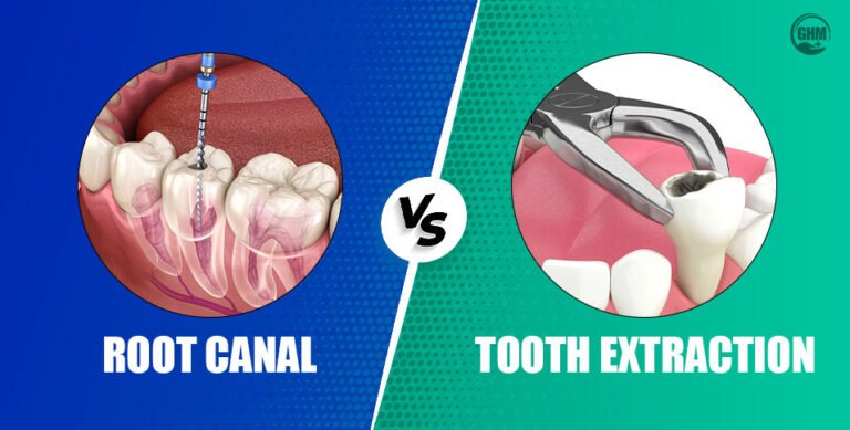 Root Canal vs Tooth Extraction