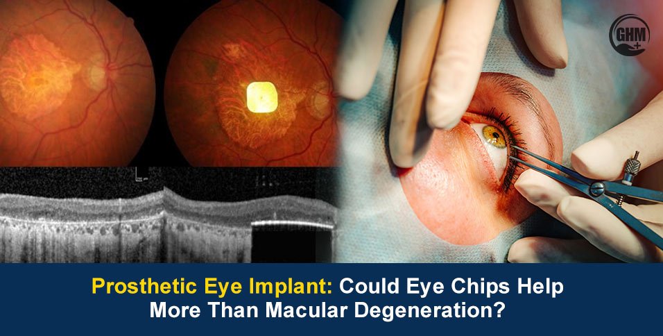 Prosthetic Eye Implant