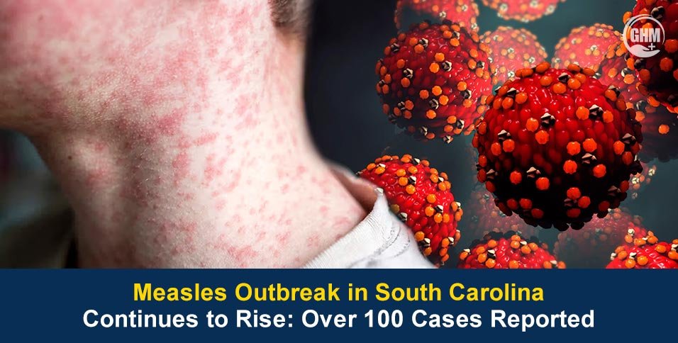 Measles Outbreak in South Carolina