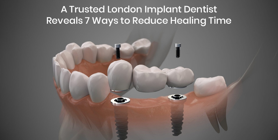 A Trusted London Implant Dentist Reveals 7 Ways to Reduce Healing Time