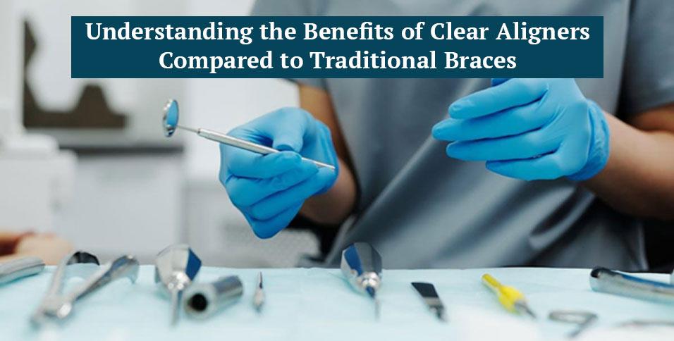 Understanding the Benefits of Clear Aligners Compared to Traditional Braces