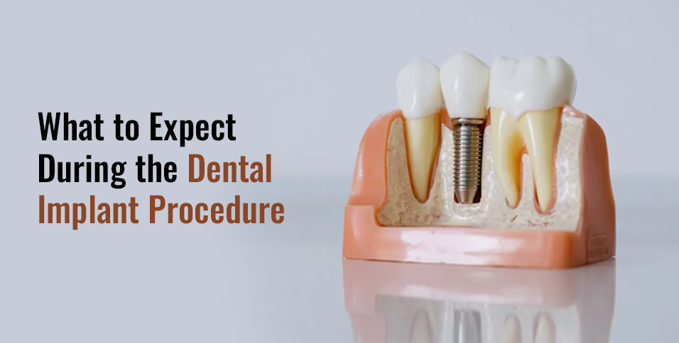 What to Expect During the Dental Implant Procedure