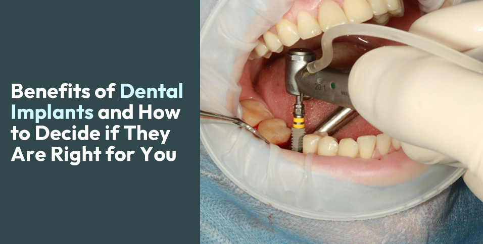 Benefits of Dental Implants and How to Decide if They Are Right for You