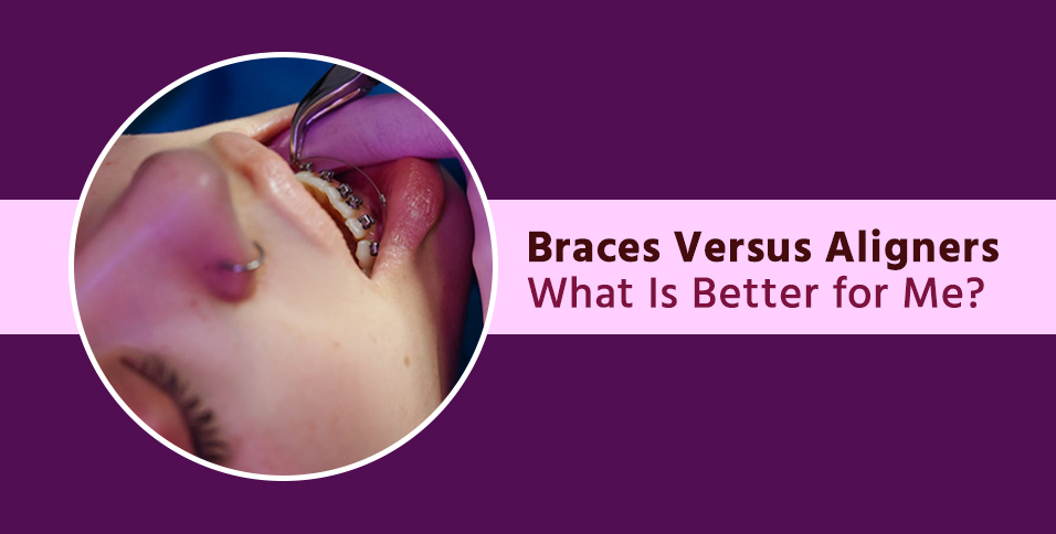 Braces Versus Aligners: What Is Better for Me?