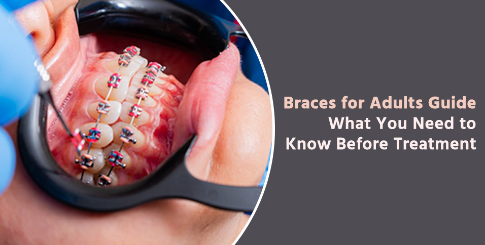 Braces for Adults Guide: What You Need to Know Before Treatment
