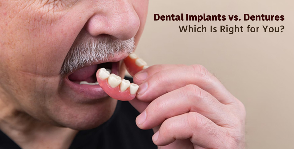 Dental Implants vs. Dentures: Which Is Right for You?