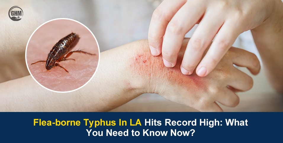 Flea-borne Typhus In LA Hits Record High: What You Need to Know Now?