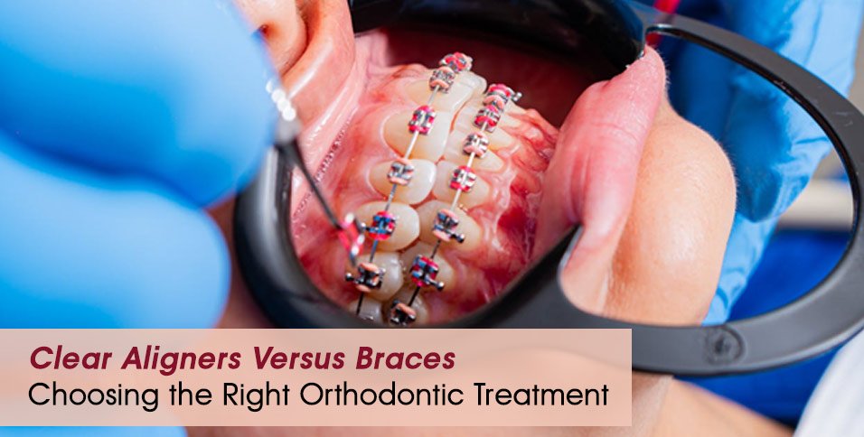Clear Aligners Versus Braces: Choosing the Right Orthodontic Treatment