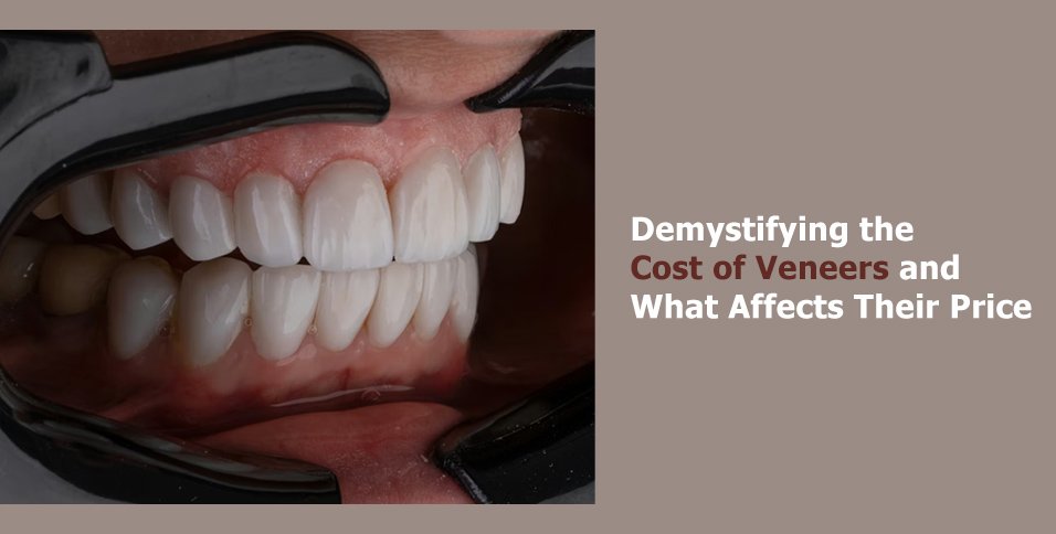 Demystifying the Cost of Veneers and What Affects Their Price