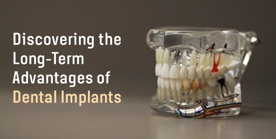 Discovering the Long-Term Advantages of Dental Implants