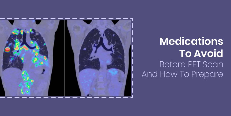 Medications To Avoid Before PET Scan And How To Prepare
