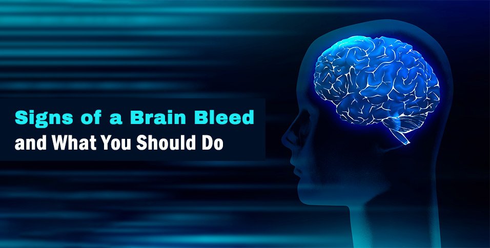Signs of a Brain Bleed and What You Should Do