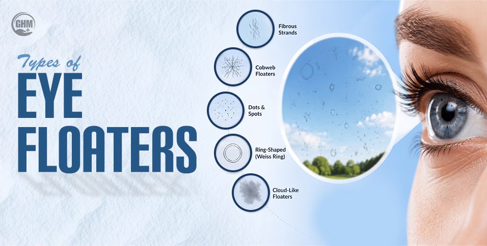 Types of Eye Floaters: When You See Spots, Cobwebs Or Rings