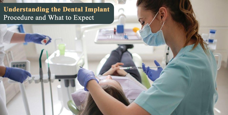 Understanding the Dental Implant Procedure and What to Expect