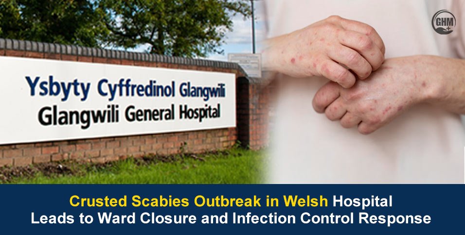 Crusted Scabies Outbreak in Welsh Hospital Closes Ward
