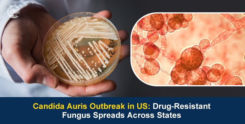Candida Auris Outbreak in US: Drug-Resistant Fungus Spreads Across States