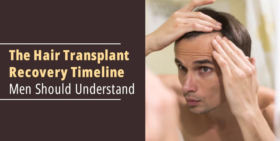 The Hair Transplant Recovery Timeline Men Should Understand