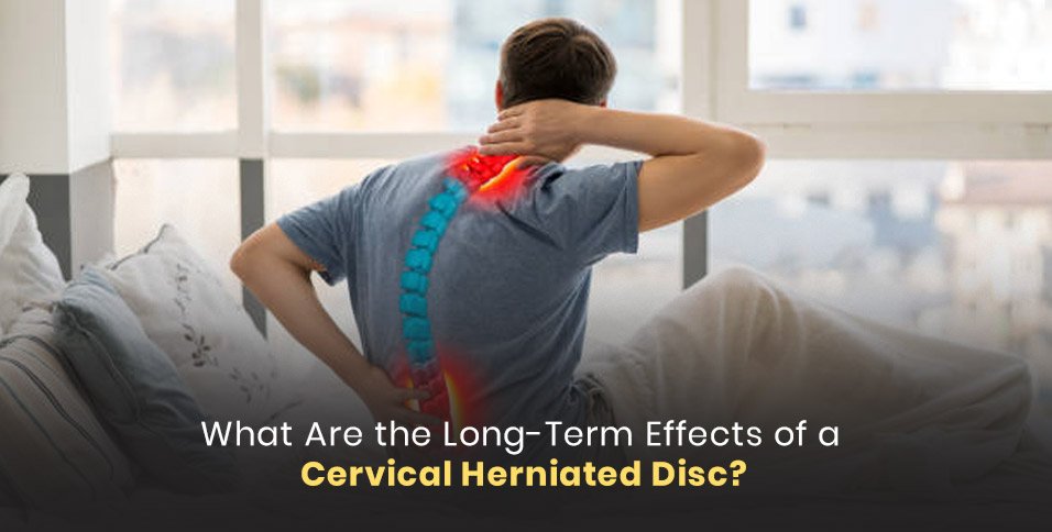 What Are the Long-Term Effects of a Cervical Herniated Disc?