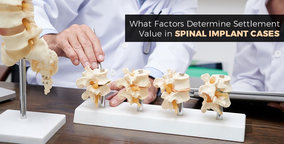 What Factors Determine Settlement Value in Spinal Implant Cases